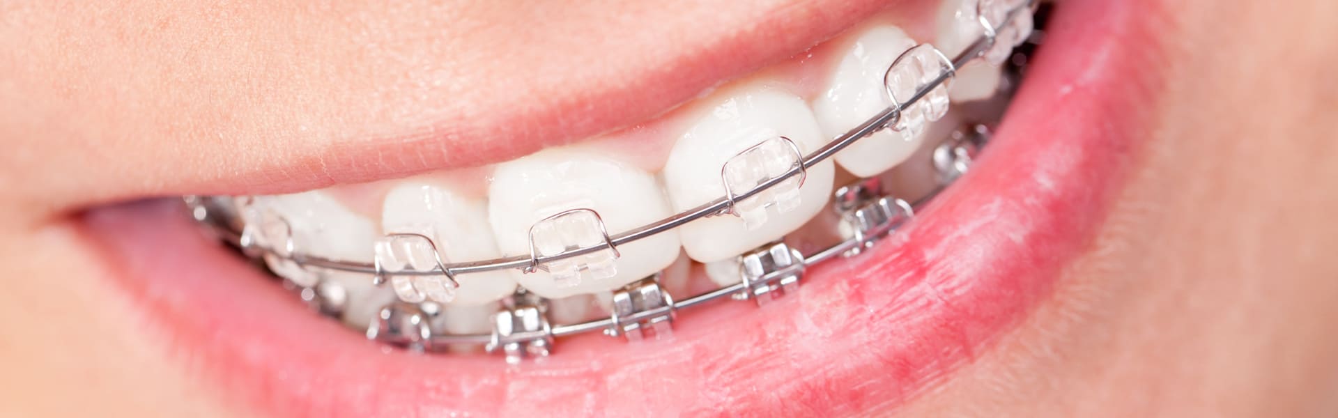 Kieferorthopaedie Dr Ulf Gollub selbstligierende Brackets